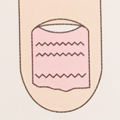 爪表面のトラブル